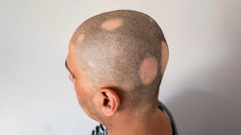 Alopecia Areata